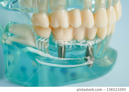 Dental implant, artificial tooth roots into jaw, root canal of dental treatment, gum disease, teeth model for dentist studying about dentistry. 136521093
