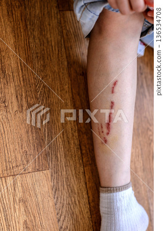 close up scar on skin. The wound form scabs on leg. close up scar on skin. The wound form scabs on leg. 136534708