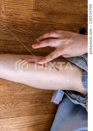 close up scar on skin. The wound form scabs on leg. close up scar on skin. The wound form scabs on leg. 136534709