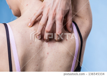 Woman with skin problem acne on back Woman with skin problem acne on back 136545334