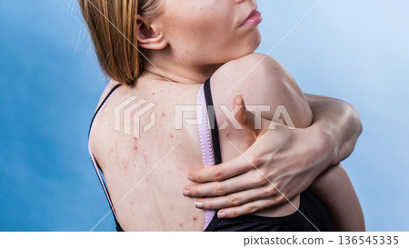Woman with skin problem acne on back Woman with skin problem acne on back 136545335