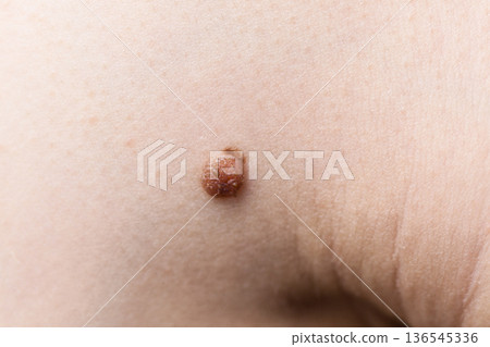 person having dark fibroma, dermatology problem on skin. Close up of papilloma dermatosis 136545336