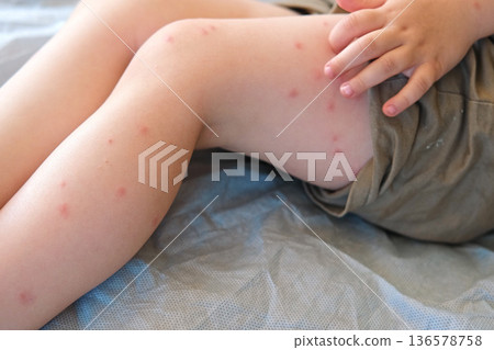 Child scratch body has sensitive itchy skin. Bodily rash. Kid allergy closeup. Little baby scratches eruption. Irritation, hive. Pruritus. Mosquito insect bite. Red from sunburn, Seborrheic Dermatitis 136578758