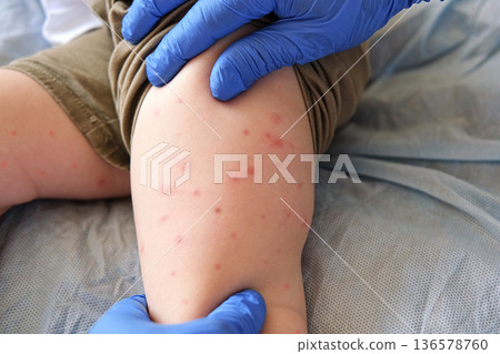 Doctor examining child with bodily red rash. Kid allergy closeup. Little baby scratches an eruption. Nurse applies special cream to atopic skin. Dermatitis, irritation, hive. Pruritus. Mosquito bites 136578760