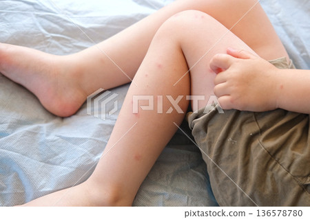 Child scratch body has sensitive itchy skin. Bodily rash. Kid allergy closeup. Little baby scratches eruption. Irritation, hive. Pruritus. Mosquito insect bite. Red from sunburn, Seborrheic Dermatitis 136578780