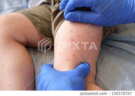 Doctor examining child with bodily red rash. Kid allergy closeup. Little baby scratches an eruption. Nurse applies special cream to atopic skin. Dermatitis, irritation, hive. Pruritus. Mosquito bites 136578787
