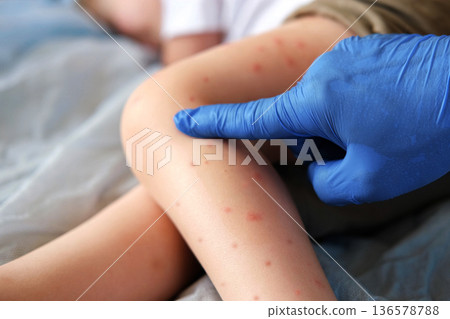 Doctor examining child with bodily red rash. Kid allergy closeup. Little baby scratches an eruption. Nurse applies special cream to atopic skin. Dermatitis, irritation, hive. Pruritus. Mosquito bites 136578788