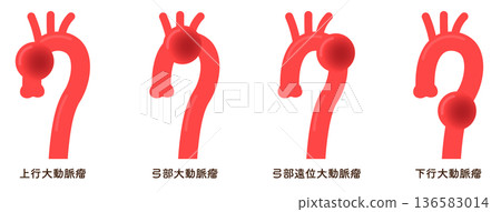 主動脈瘤示意圖 主動脈瘤示意圖 136583014