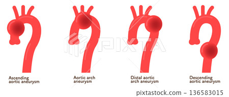 主動脈瘤示意圖 主動脈瘤示意圖 136583015