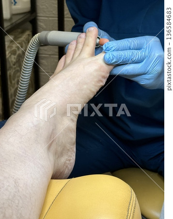 Hardware medical pedicure using a drill and nail files. A patient has a pedicure at a podiatrist. A dangerous fungal lesion of human toenails. Onychomycosis, treatment of nail fungus. 136584683