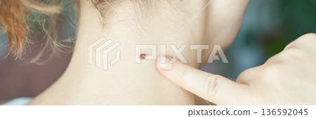Close-up of female finger pointing at mole on caucasian adults neck Close-up of female finger pointing at mole on caucasian adults neck 136592045