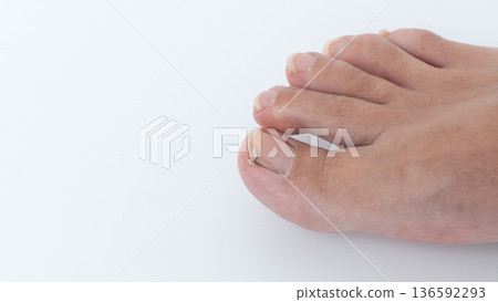 Close-up view of a human foot with a nail infection, showcasing damaged nail texture and skin condition, emphasizing health and hygiene concerns Close-up view of a human foot with a nail infection, showcasing damaged nail texture and skin condition, emphasizing health and hygiene concerns 136592293