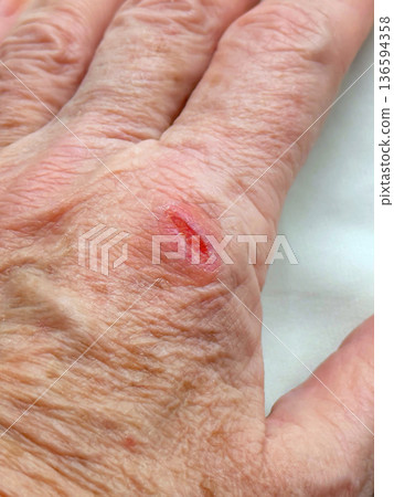 Close up of hand with open wound and skin injury showing cut, inflammation and tissue damage on surface. Concept of First Aid Care, skin injury, wound care, medical treatment 136594358