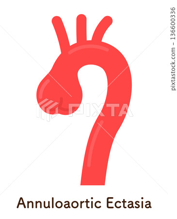 主動脈瓣環擴張（AAE）示意圖 136600336