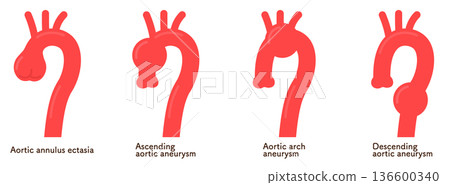 Aortic Annular Ectoses and Aortic Aneurysms 136600340