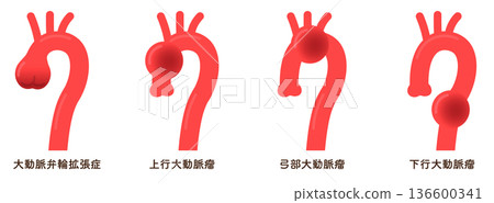 Aortic Annular Ectoses and Aortic Aneurysms 136600341