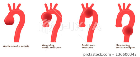 Aortic Annular Ectoses and Aortic Aneurysms 136600342