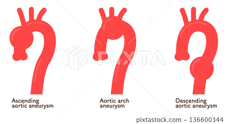 Illustration of an aortic aneurysm 136600344