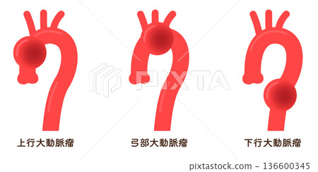 Illustration of an aortic aneurysm 136600345