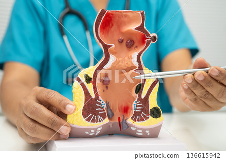 Asian doctor with rectum and hemorrhoid human anatomy model at hospital, inflamed vascular structure. 136615942