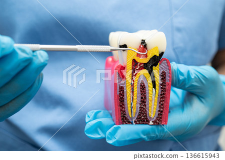 Dentist holding dental implant, artificial tooth roots into jaw, root canal of dental treatment, gum disease, teeth model for dentist. Dentist holding dental implant, artificial tooth roots into jaw, root canal of dental treatment, gum disease, teeth model for dentist. 136615943