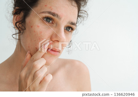 portrait of a young teenage girl with pimples and acne on problematic facial skin. Face of adult woman with bad red inflamed skin and acne in close-up on white isolated background portrait of a young teenage girl with pimples and acne on problematic facial skin. Face of adult woman with bad red inflamed skin and acne in close-up on white isolated background 136620946