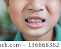 Close up of Asian boy mouth with unhealthy teeth, dental caries, plaque and yellow stains. Concept of childhood dental hygiene, tooth decay problem, gingivitis, and pediatric dentistry treatment. 136668362