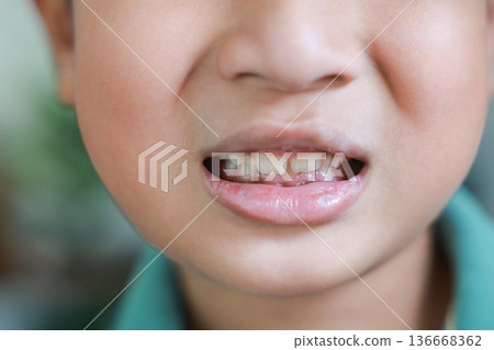 Close up of Asian boy mouth with unhealthy teeth, dental caries, plaque and yellow stains. Concept of childhood dental hygiene, tooth decay problem, gingivitis, and pediatric dentistry treatment. 136668362