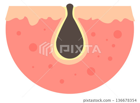 Clogged skin pore. Cartoon blackhead problem icon 136678354