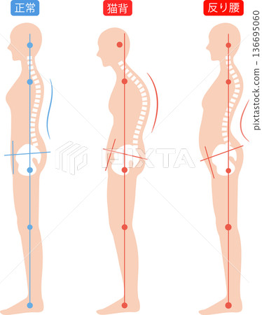 Correct posture and hunchback and arched back women's spine and pelvis 136695060