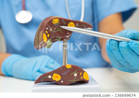 Cirrhosis, Liver cancer, fatty liver, Asian doctor with liver human model. 136699674
