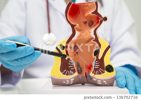 Asian doctor with rectum and hemorrhoid human anatomy model at hospital, inflamed vascular structure. 136702716