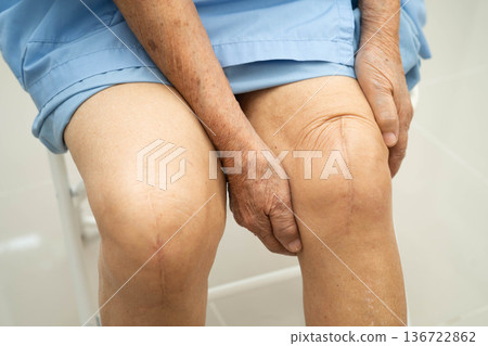 Asian elderly woman patient with scar knee replacement surgery in hospital. Asian elderly woman patient with scar knee replacement surgery in hospital. 136722862