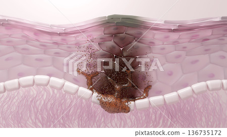 Cross-section of skin where melanocytes produce melanin, resulting in pigmentation and age spots 136735172
