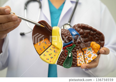 Cirrhosis, Liver cancer, fatty liver, Asian doctor with liver human model. 136738559