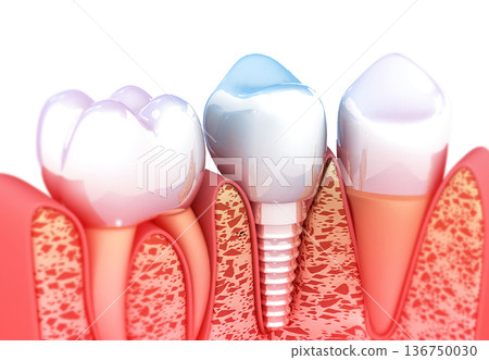 Tooth implant 136750030