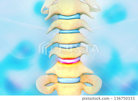 Disc problem of human spine Disc problem of human spine 136750333