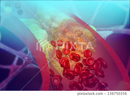 Cholesterol blocking artery Cholesterol blocking artery 136750356