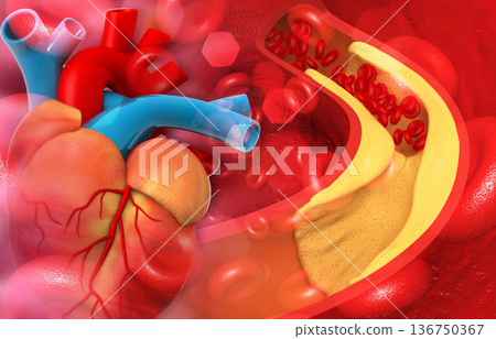 Human heart artery blocked with cholesterol 136750367