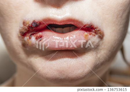 Staphylococcus infection on lips. Crack in the corner of the mouth, sores around the mouth, sore on the lips with dry blood on the woman face. Staphylococcus infection on lips. Crack in the corner of the mouth, sores around the mouth, sore on the lips with dry blood on the woman face. 136753615