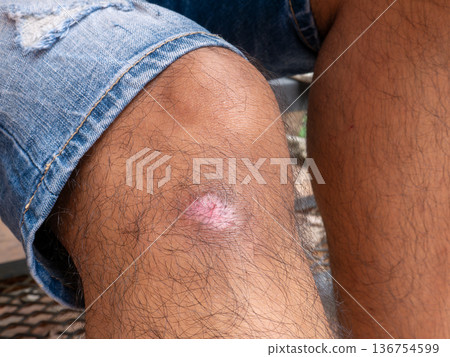 Knee Wound Bruise Injury on Human Leg Skin Medical Health Care Concept Close-Up 136754599