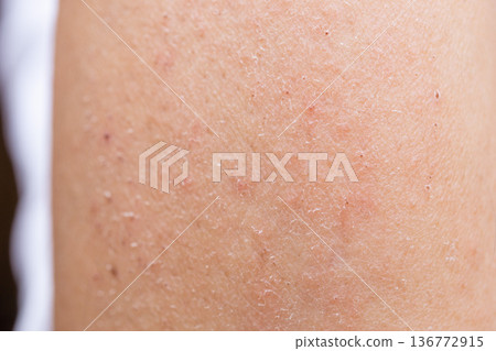 Skin rash, eczema, sores Skin rash, eczema, sores 136772915