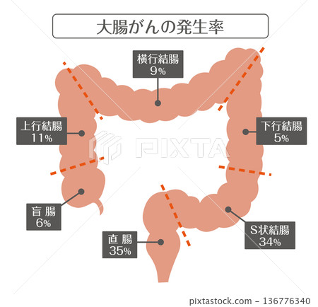 大腸癌發生率及各部位結構示意圖 136776340