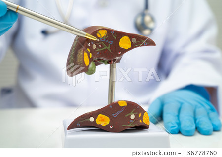 Cirrhosis, Liver cancer, fatty liver, Asian doctor with liver human anatomy model in World Hepatitis Day at hospital. Cirrhosis, Liver cancer, fatty liver, Asian doctor with liver human anatomy model in World Hepatitis Day at hospital. 136778760