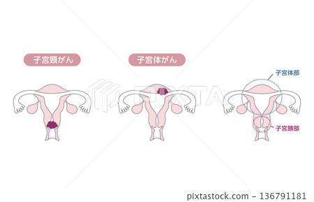 一幅醫學插圖，展示了子宮頸癌和子宮內膜癌的差異。 136791181