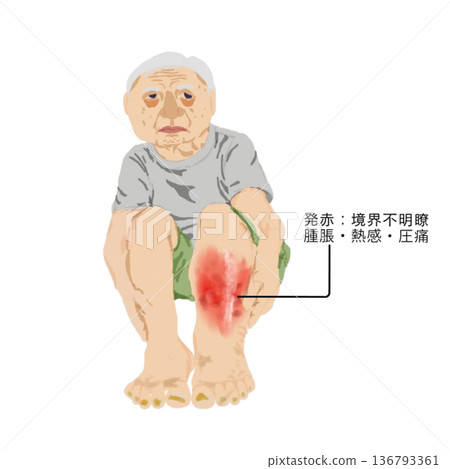 蜂窩性組織炎的症狀:老年人小腿出現紅腫、發熱和觸痛的醫學插圖 蜂窩性組織炎的症狀:老年人小腿出現紅腫、發熱和觸痛的醫學插圖 136793361