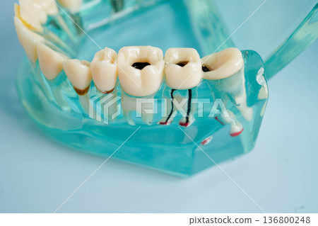Dental implant, artificial tooth roots into jaw, root canal of dental treatment, gum disease, teeth model for dentist studying about dentistry. Dental implant, artificial tooth roots into jaw, root canal of dental treatment, gum disease, teeth model for dentist studying about dentistry. 136800248