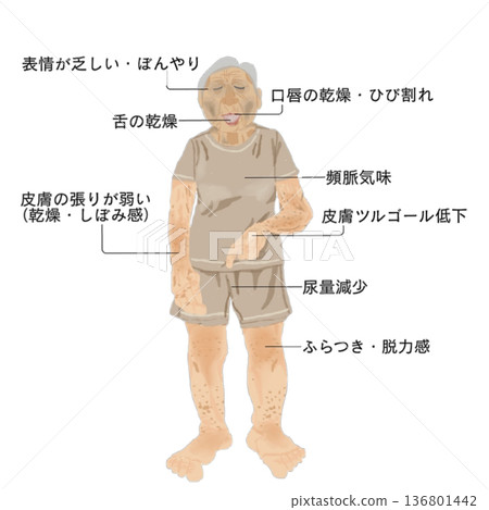 Checking for dehydration in the elderly | Medical illustrations of whole-body findings and observation points Checking for dehydration in the elderly | Medical illustrations of whole-body findings and observation points 136801442