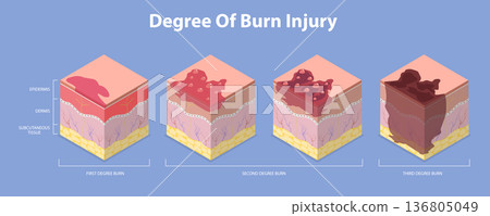 3D Isometric Flat Vector Illustration of Skin Burn Degree, Stages In Epidermis And Dermis Layers 136805049