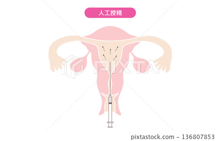 人工授精圖像說明 人工授精圖像說明 136807853